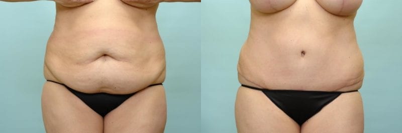 Patient Tummy Tuck Before and Afters Tummy Tuck Before After Arlington -  Fort Worth TX - Accent On You