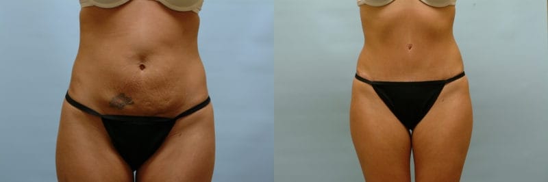 Patient Tummy Tuck Before and Afters Tummy Tuck Before After Arlington -  Fort Worth TX - Accent On You