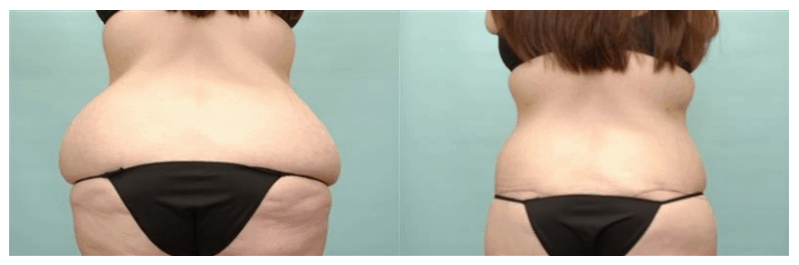 Mini Tummy Tuck Archives - Accent On You